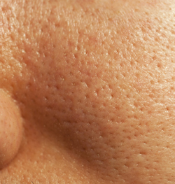 enlarged pores