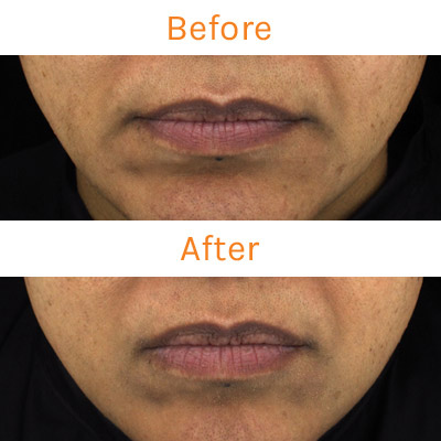 lux renew clinical trial, before and after