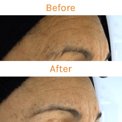 lux renew clinical trial, before and after