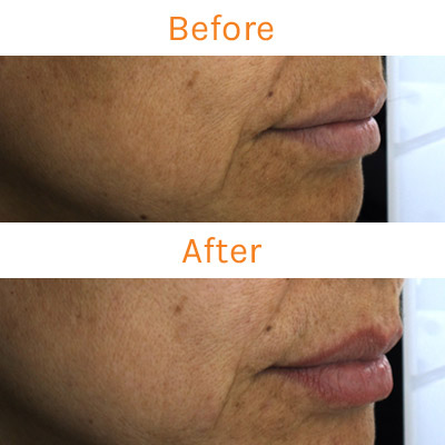 lux renew clinical trial, before and after