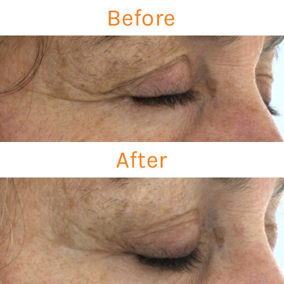 lux renew clinical trial, before and after