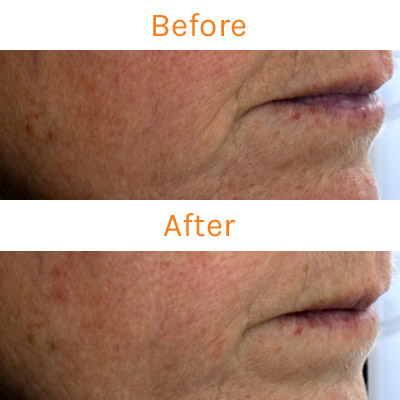 lux renew clinical trial, before and after