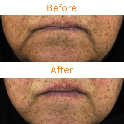 lux renew clinical trial, before and after