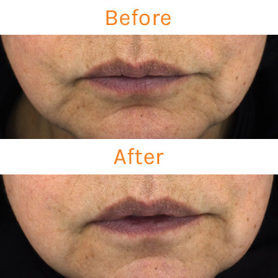 lux renew clinical trial, before and after