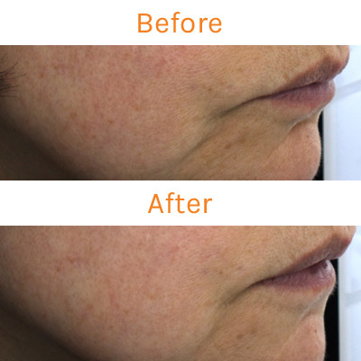 lux renew clinical trial, before and after