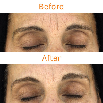 lux renew clinical trial, before and after