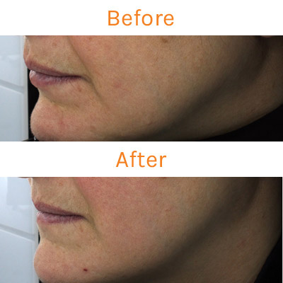 lux renew clinical trial, before and after