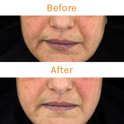 lux renew clinical trial, before and after