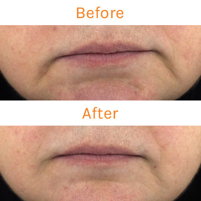 lux renew clinical trial, before and after